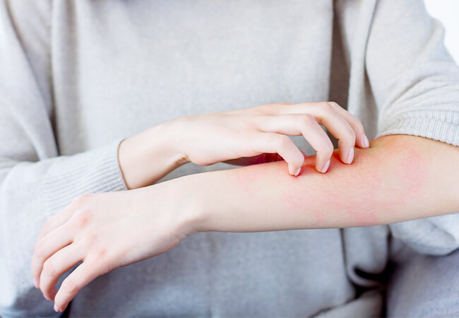 アレルギーで肌に炎症が起きている女性